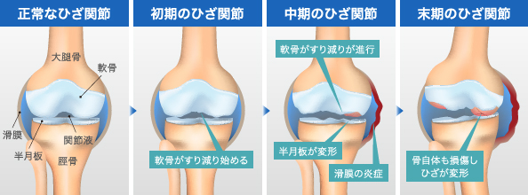 正常なひざ関節 初期のひざ関節 中期のひざ関節 末期のひざ関節