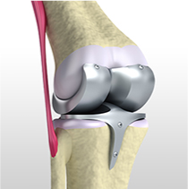 変形性膝関節症の手術的治療