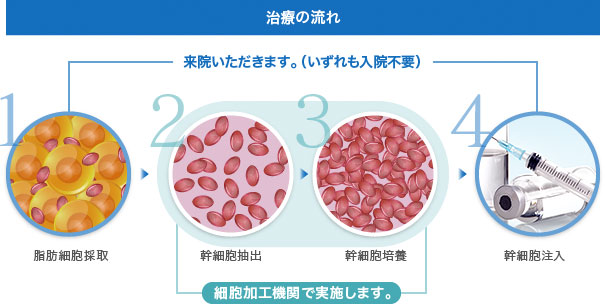 培養幹細胞治療の流れ　脂肪採取から患者様に投与するまで