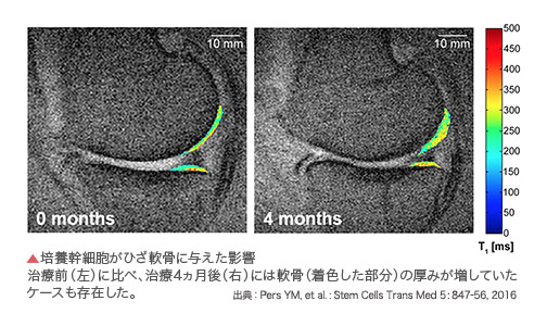 培養幹細胞がひざ軟骨に与えた影響 治療前（左）に比べ、治療4ヵ月後（右）には軟骨（着色した部分）の厚みが増していたケースも存在した。 出典：pers ym, et al. : stem cells trans med 5: 847-56, 2016