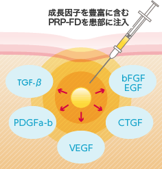 成長因子を豊富に含むPRP-FDを患部に注入