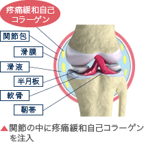 関節の中にSCAFFを注入